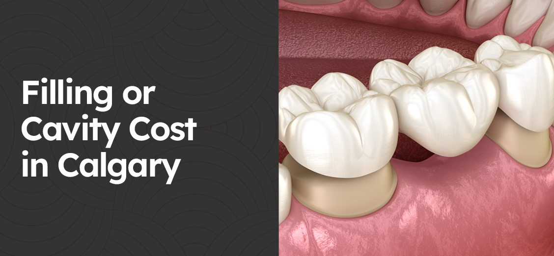 Filling or Cavity Cost in Calgary